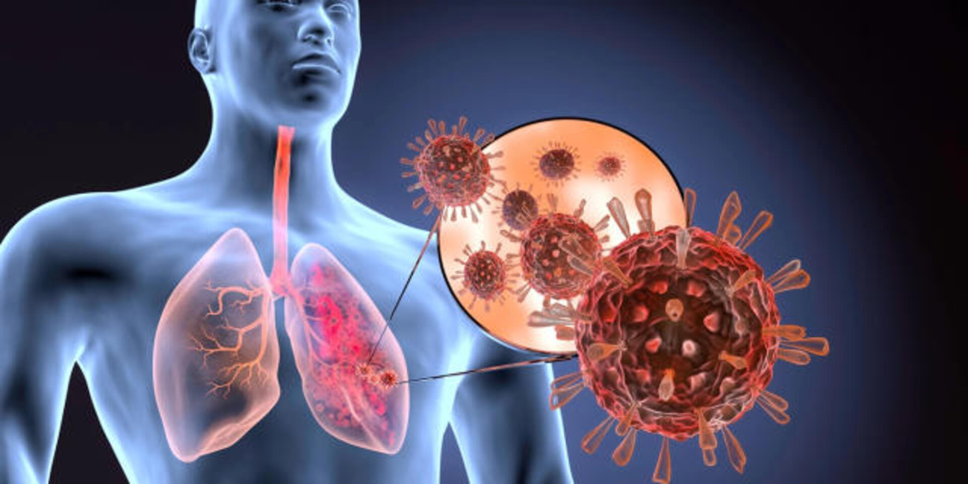 O VSR é o responsável por 75% das bronquiolites.