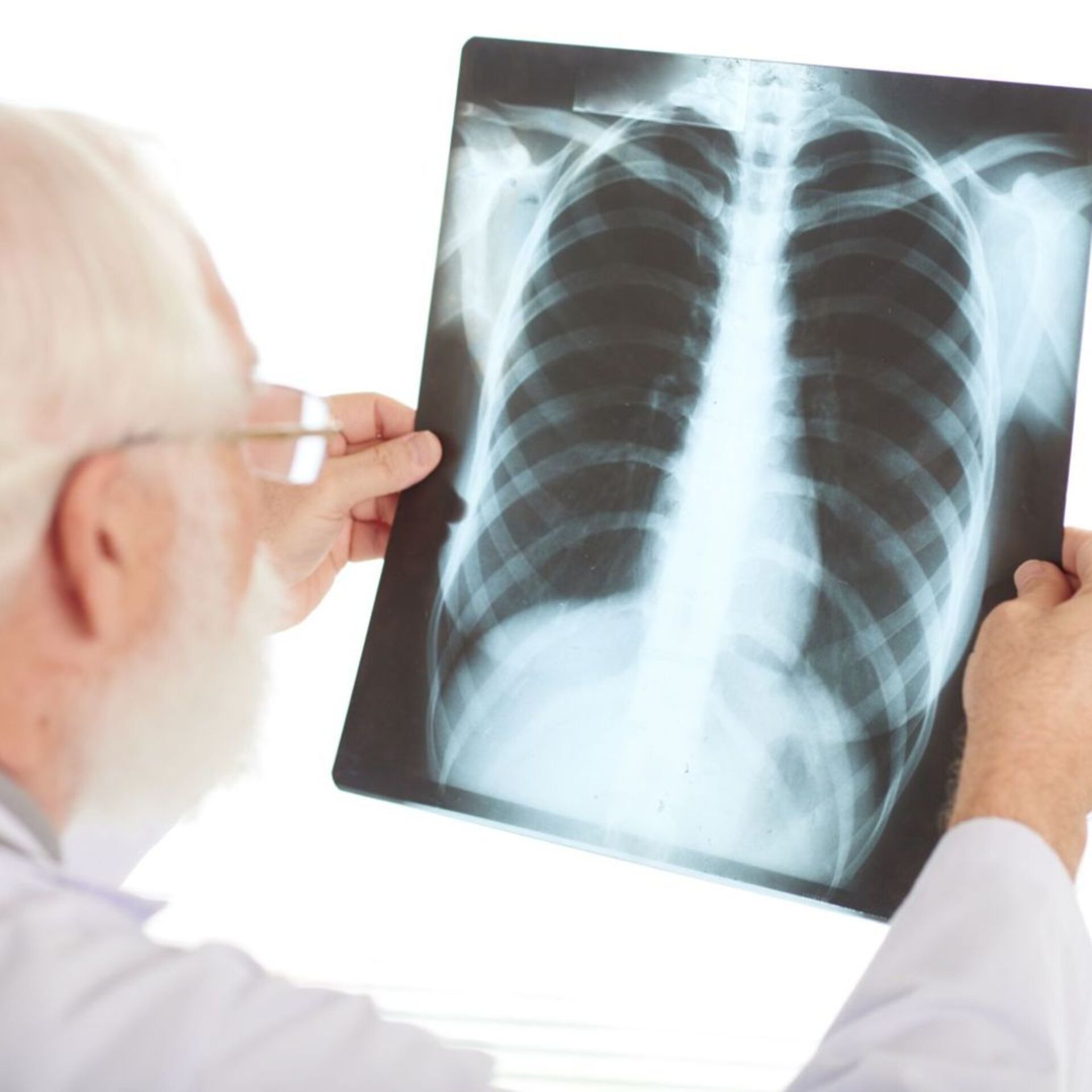 OAB Barro Preto - Estado monitora casos de tuberculose em pessoas em situação de rua