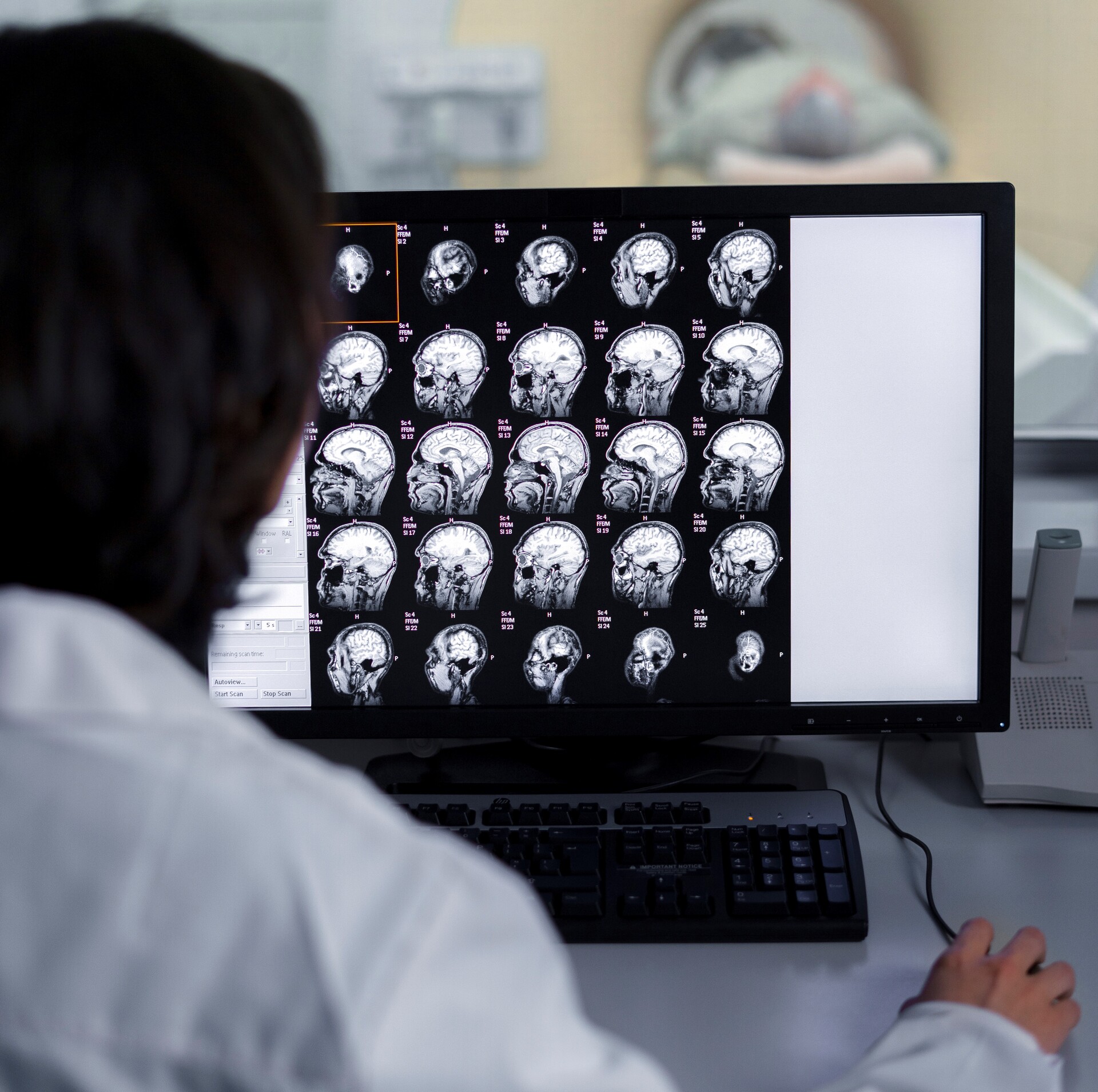 OAB Barro Preto - Diagnóstico precoce de câncer de cabeça e pescoço aumenta chances de cura para 90%